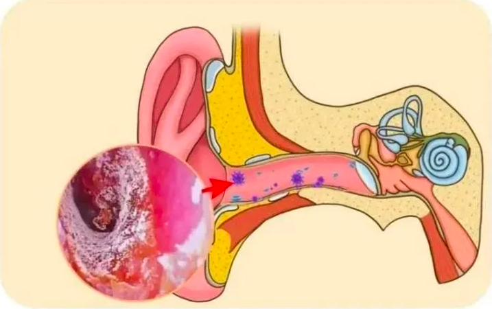 耳朵里面痒为啥什么也没掏出来可能是这几个问题